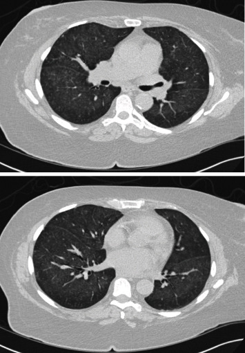 The Utility of Bronchoscopy in Hydralazine-Induced ANCA-Associated Vasculitis.