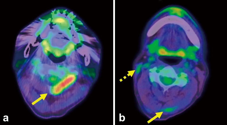 Myotomy and Selective Peripheral Denervation Based on <sup>18</sup>F-FDG PET/CT in Intractable Cervical Dystonia: A Case Report.