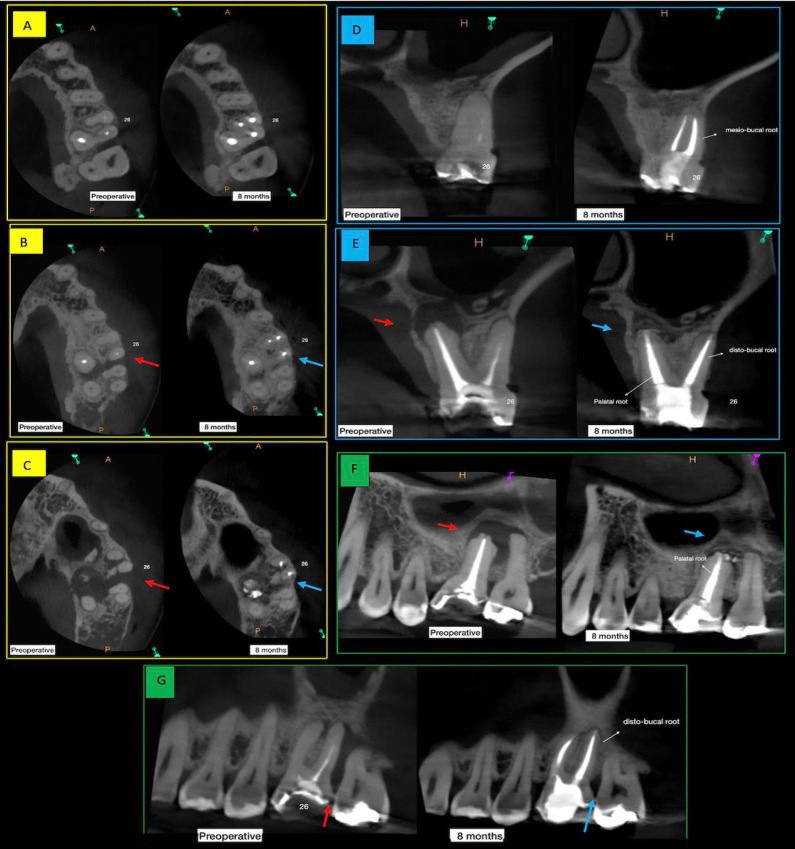 Bioceramic Cements: Supporting in Remineralization of Osteolytic Lesions in Endodontic-periodontal Diseases: A Report of Two Cases.