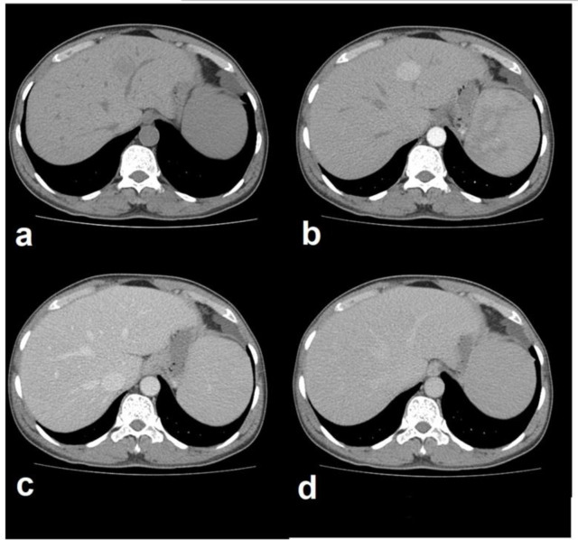 Isolated focal intrahepatic extramedullary hematopoiesis mimicking hepatocellular carcinoma in a cirrhotic patient with secondary hemochromatosis from thalassemia.