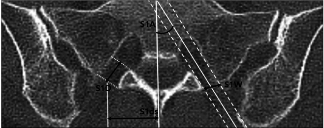 Measurement of S1 foramen depth for ultrasound-guided S1 transforaminal epidural injection.