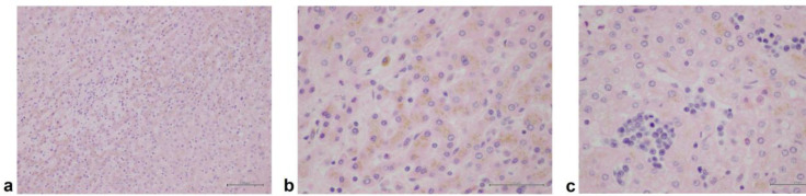 Isolated focal intrahepatic extramedullary hematopoiesis mimicking hepatocellular carcinoma in a cirrhotic patient with secondary hemochromatosis from thalassemia.