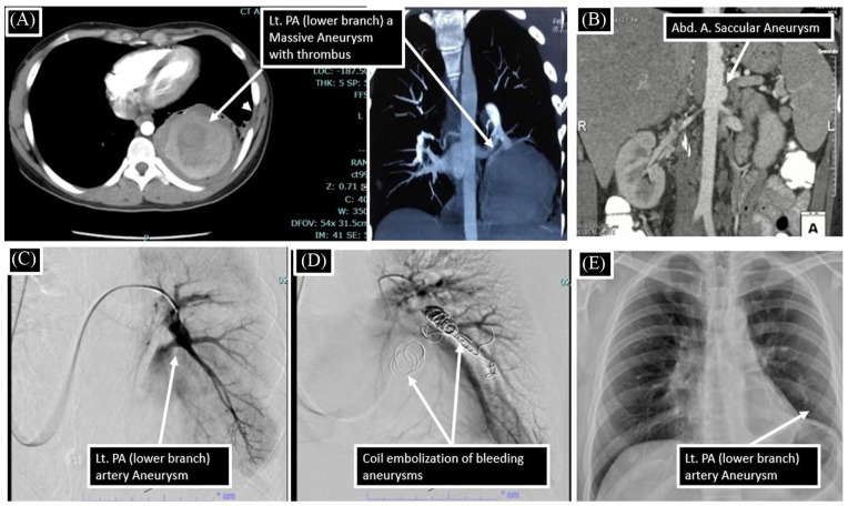 Hughes-Stovin Syndrome: An Experience of Management of 3 Cases From a Tertiary Health Care Centre.