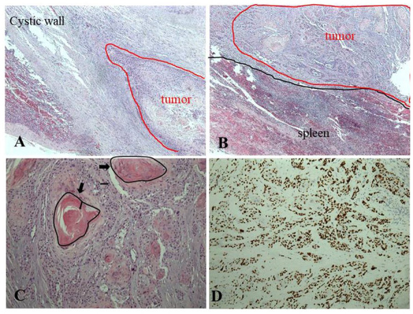 Primary Squamous Cell Carcinoma of the Pancreas From a Large Cyst: A Case Report.