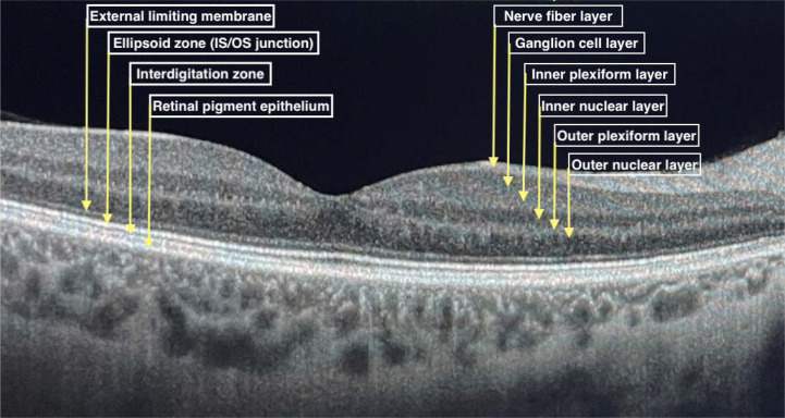 Subclinical retinopathy in systemic lupus erythematosus patients - optical coherence tomography study.