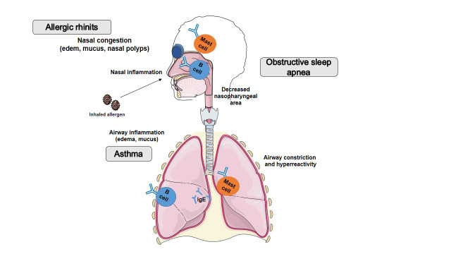 A Review Regarding the Connections between Allergic Rhinitis and Asthma - Epidemiology, Diagnosis and Treatment.