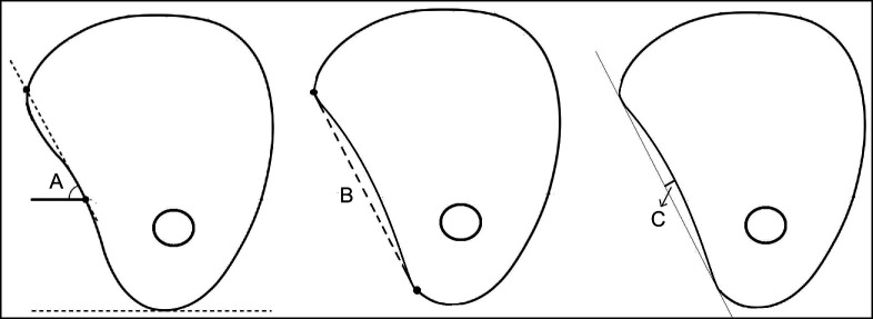 Effects of Crest Morphology on Lingual Concavity in Mandibular Molar Region: an Observational Study.