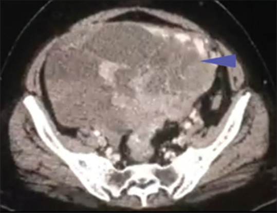 Skin Metastases in Ovarian Malignancy: A Case Report with Literature Review.