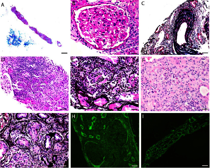 Antitubular Basement Membrane Antibody Disease Associated with Nivolumab Infusion and Concomitant Acute Pyelonephritis Leading to Acute Kidney Injury : a Case Report and Literature Review.