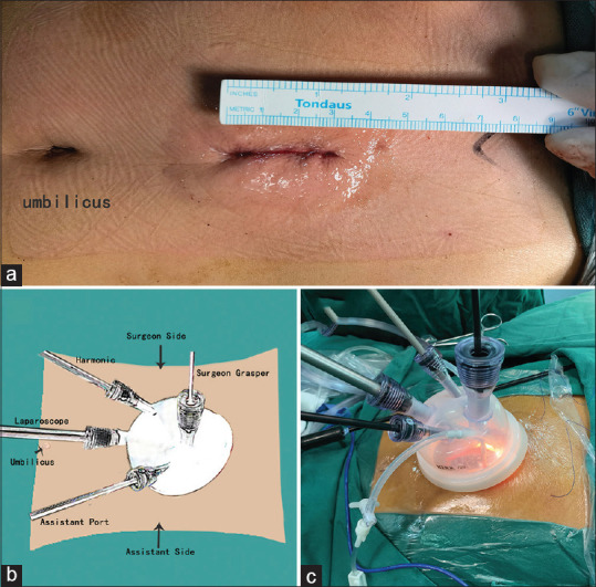 Application of single-port laparoscopic retrograde gastric mobilization during McKeown esophagectomy for esophageal cancer.