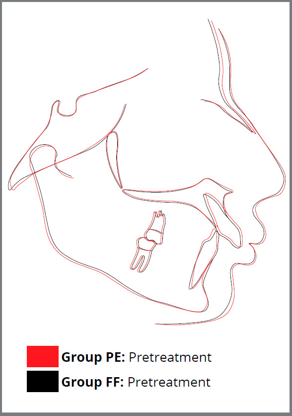 Treatment effects and lip profile changes following premolars extraction treatment vs fixed functional treatment in Class II division 1 malocclusion: A randomized controlled clinical trial.