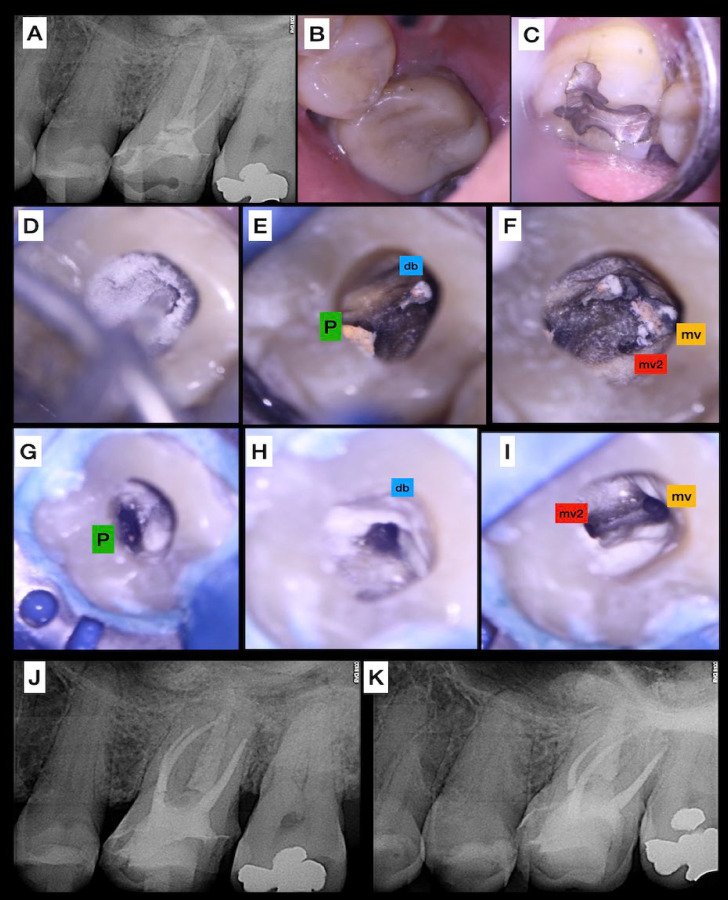 Bioceramic Cements: Supporting in Remineralization of Osteolytic Lesions in Endodontic-periodontal Diseases: A Report of Two Cases.