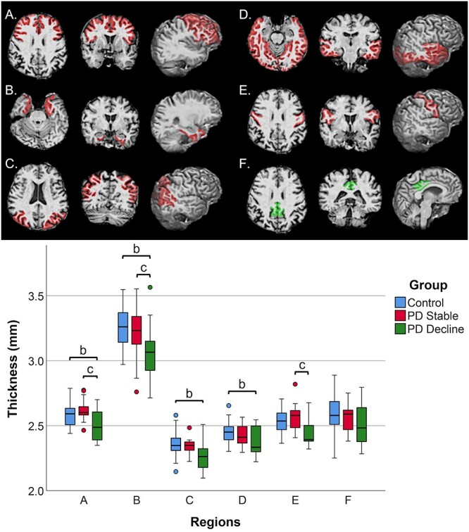 Cerebral cortical thickness and cognitive decline in Parkinson's disease.