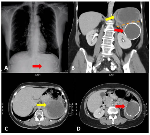 Primary Squamous Cell Carcinoma of the Pancreas From a Large Cyst: A Case Report.