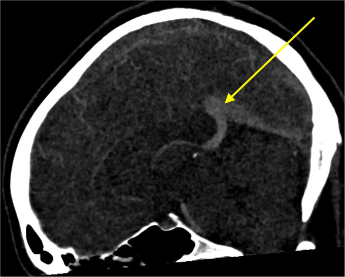 <i>Cerebral venous sinus thrombosis following</i> ChAdOx1 nCoV-19 AstraZeneca COVID-19 vaccine.