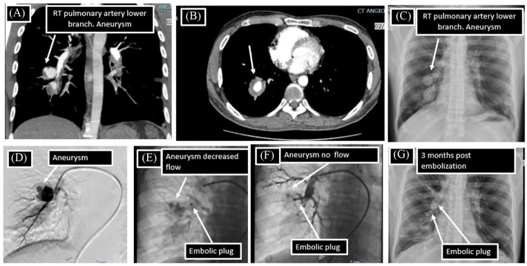 Hughes-Stovin Syndrome: An Experience of Management of 3 Cases From a Tertiary Health Care Centre.