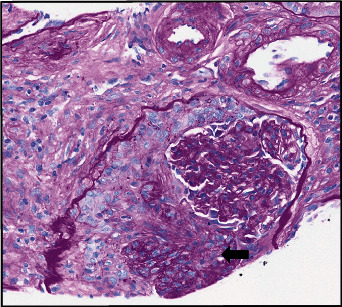 The Utility of Bronchoscopy in Hydralazine-Induced ANCA-Associated Vasculitis.