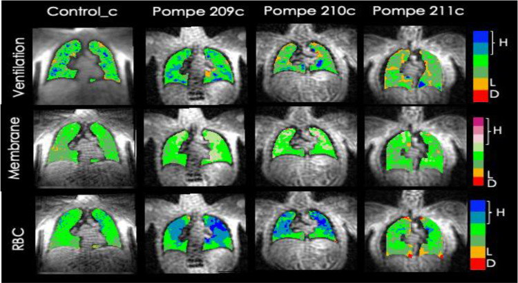 Monitoring and Management of Respiratory Function in Pompe Disease: Current Perspectives.