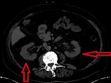 Antitubular Basement Membrane Antibody Disease Associated with Nivolumab Infusion and Concomitant Acute Pyelonephritis Leading to Acute Kidney Injury : a Case Report and Literature Review.