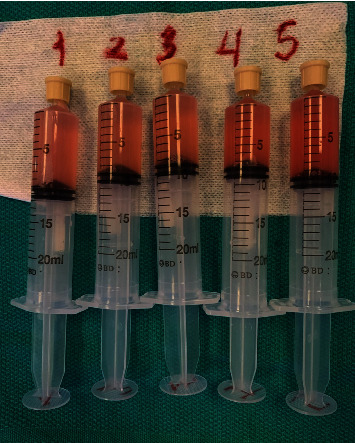 The Utility of Bronchoscopy in Hydralazine-Induced ANCA-Associated Vasculitis.