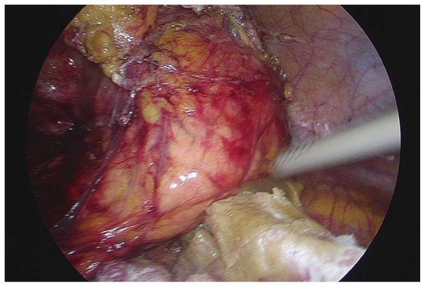 Primary Squamous Cell Carcinoma of the Pancreas From a Large Cyst: A Case Report.