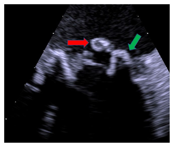 A Case of Catastrophic <i>Aspergillus</i> Endocarditis.