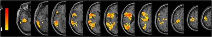 Language function of the superior longitudinal fasciculus in patients with arteriovenous malformation as evidenced by automatic fiber quantification.