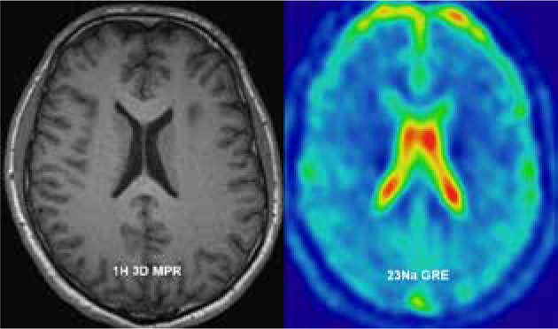 Assessment of sodium (<sup>23</sup>Na) brain MRI at 3T - preliminary results.