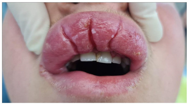 Treatment of Orofacial Granulomatosis-9-Month Follow-up: A Case Report.