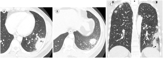 Clinicoradiological Features of Pulmonary Cryptococcosis in Immunocompetent Patients.