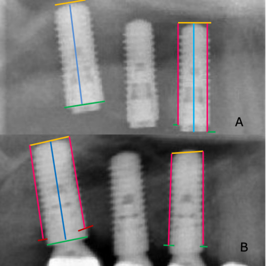 Prosthetically guided oral implant surgery. A retrospective cohort study evaluating the 5-year surgical outcome.