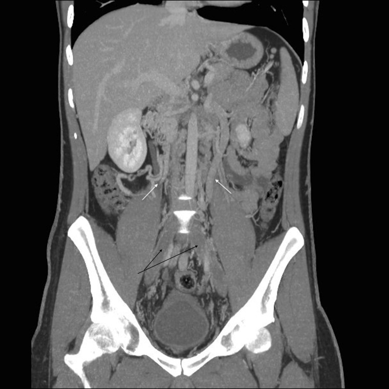 A rare cause of deep vein thrombosis: inferior vena cava agenesis.