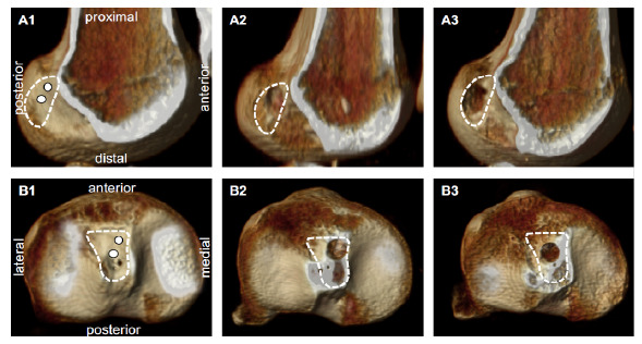 ANTEROMEDIAL OR CENTRAL ANATOMIC ACL RECONSTRUCTION? A CADAVERIC HIP-TO-TOE STUDY.