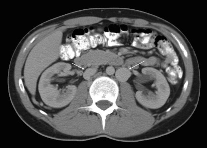 A rare cause of deep vein thrombosis: inferior vena cava agenesis.