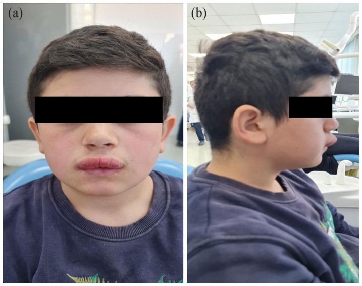 Treatment of Orofacial Granulomatosis-9-Month Follow-up: A Case Report.