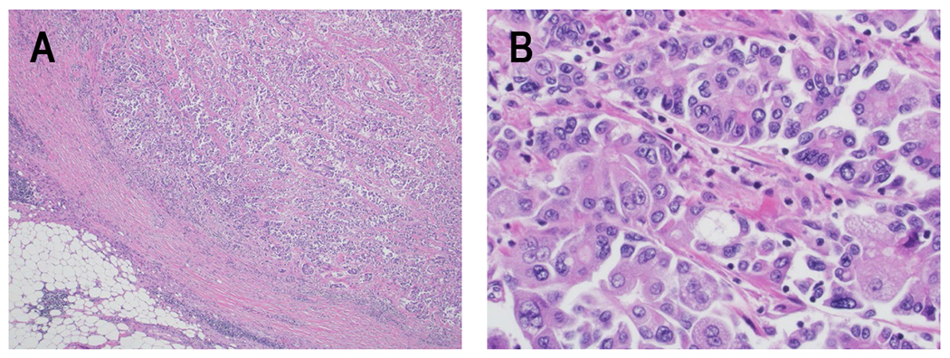 Two rare cancers of the exocrine pancreas: to treat or not to treat like ductal adenocarcinoma?