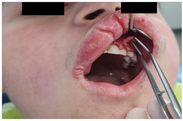 Treatment of Orofacial Granulomatosis-9-Month Follow-up: A Case Report.