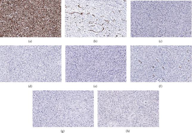 Jejunal Intussusception Secondary to a Large Inflammatory Fibroid Polyp: A Case Report and Discussion of Differential Diagnosis.