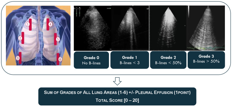 Evaluation Of Congestion Levels in Septic Patients Admitted to Critical Care Units with a Combined Venous Excess-Lung Ultrasound Score (VExLUS) - a Research Protocol.