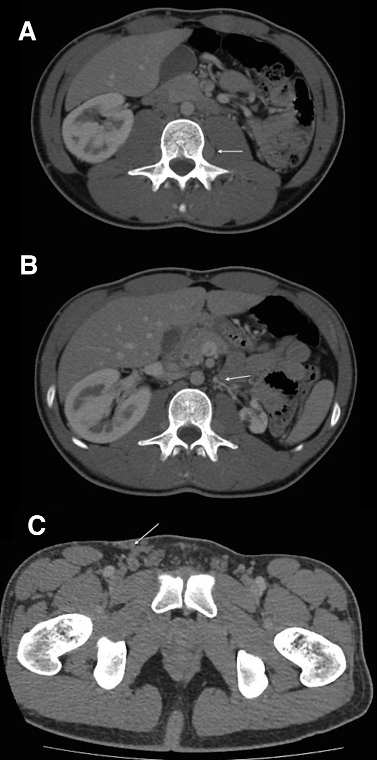 A rare cause of deep vein thrombosis: inferior vena cava agenesis.