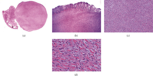 Jejunal Intussusception Secondary to a Large Inflammatory Fibroid Polyp: A Case Report and Discussion of Differential Diagnosis.