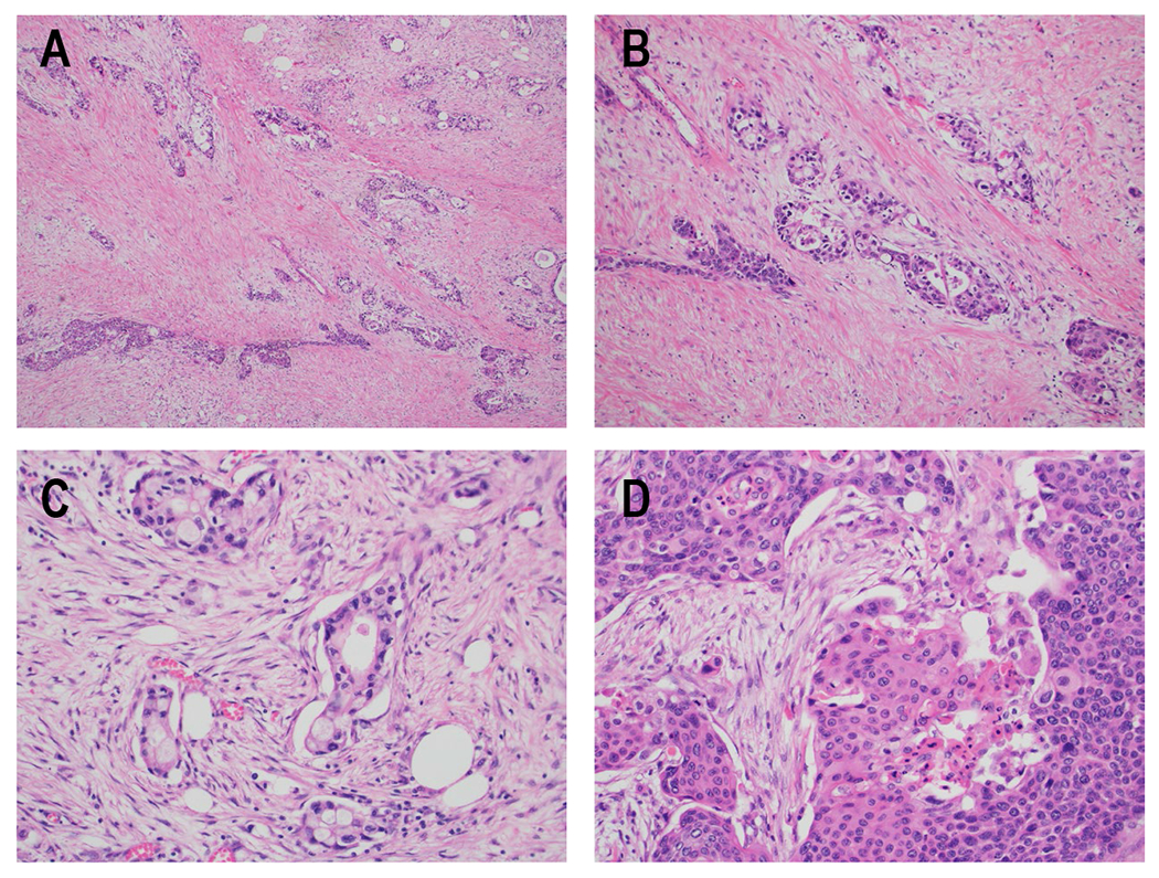 Two rare cancers of the exocrine pancreas: to treat or not to treat like ductal adenocarcinoma?