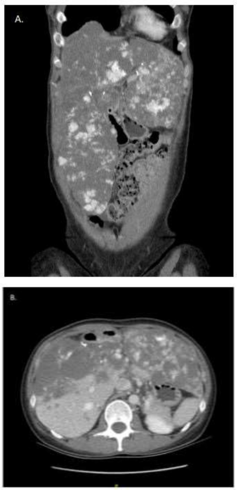 An uncommon cause of a giant abdominal mass.