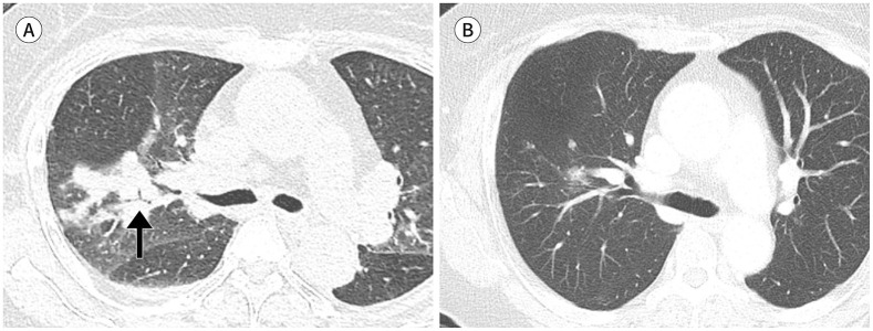 Clinicoradiological Features of Pulmonary Cryptococcosis in Immunocompetent Patients.