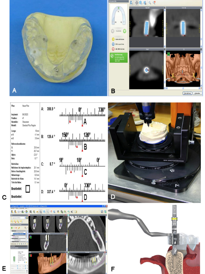 Prosthetically guided oral implant surgery. A retrospective cohort study evaluating the 5-year surgical outcome.