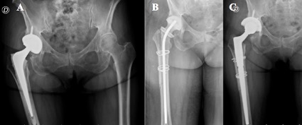 Effectiveness of two-stage revision with commercial polymethylmethacrylate articulated hip spacer: similar outcomes against monomicrobial and polymicrobial hip periprosthetic joint infections.