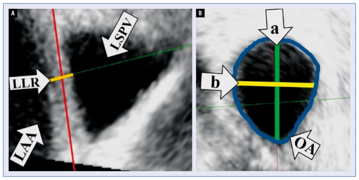 Right superior pulmonary vein parameter determined by three-dimensional transesophageal echocardiography is an independent predictor of the outcome after cryoballoon isolation of the pulmonary veins.
