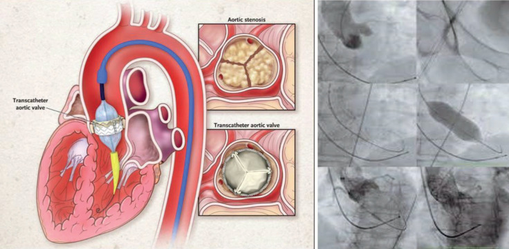 Transcatheter Aortic Valve Implantation Two Decades of Evolution - TAVI From Current Perspective.
