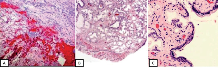 Encapsulated Hematoma of the Bartholin's Glandule.
