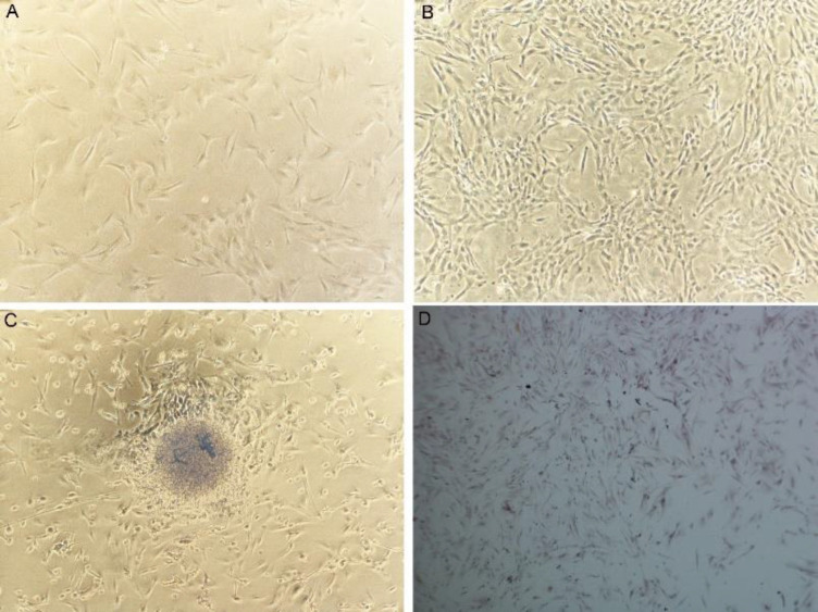 Isolation of Cells and Exosomes from Glioblastoma Tissue to Investigate the Effects of Ascorbic Acid on the c-Myc, HIF-1α, and Lnc-SNHG16 Genes.